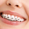 Medical Center Assistance Dental Brace