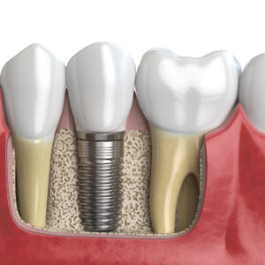 Medical Center Assistance Zirconia crown