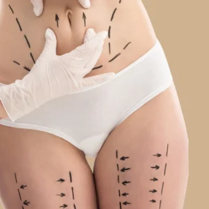 Abdominoplasty