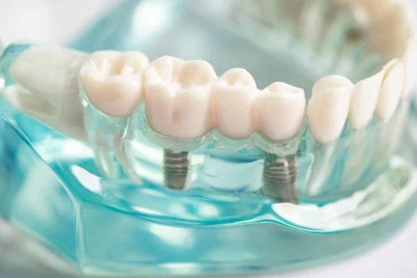 Medical Center Assistance Dental implant2