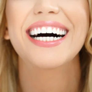 Medical Center Assistance Hollywood smile full E max Veneer