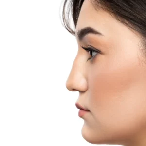 Rhinoplasty