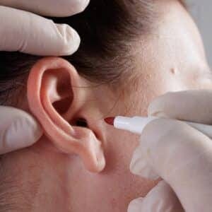 Otoplasty Ear Pinnig Surgery Package