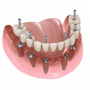 Medical center assistance all on six dental implant