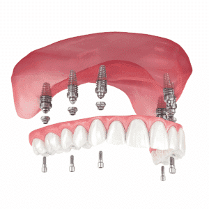 Dental Implant