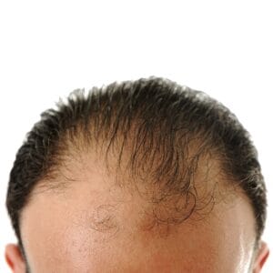 Medical Center A Assistance hair transplant
