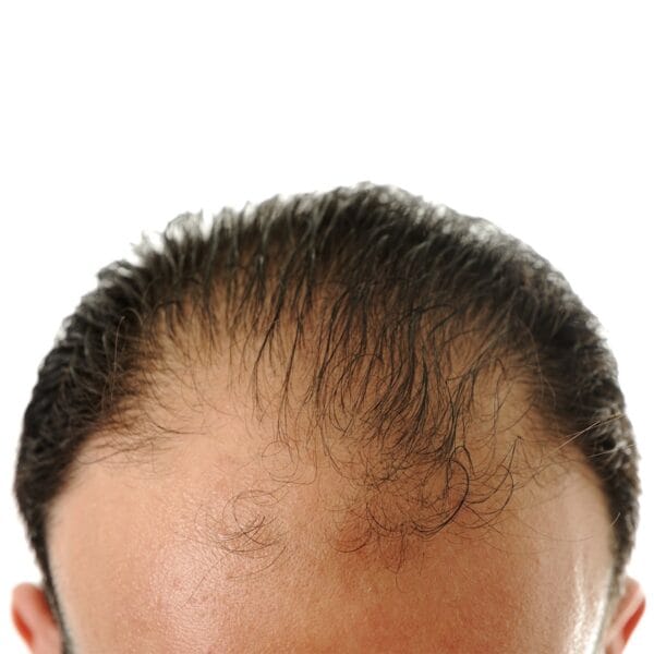 Medical Center A Assistance hair transplant