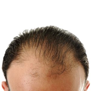 Medical Center A Assistance hair transplant